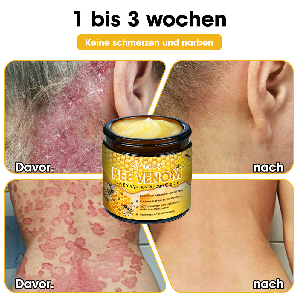 Tnnedey™ Bienengift Haut-Notfall-Rettungscreme (AAD empfohlen) 💆♀️ (Expertenempfehlung)